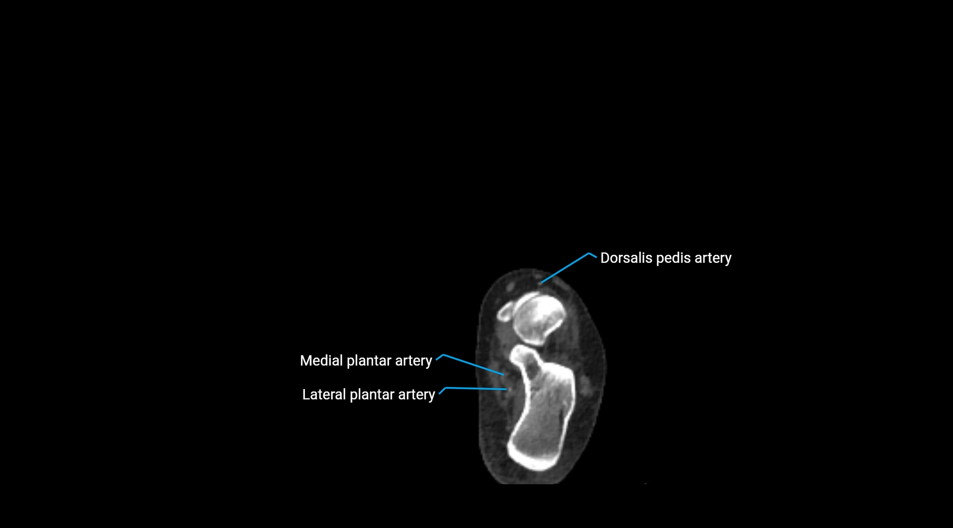 CTA lower limb cross sectional anatomy labelled image _281.webp